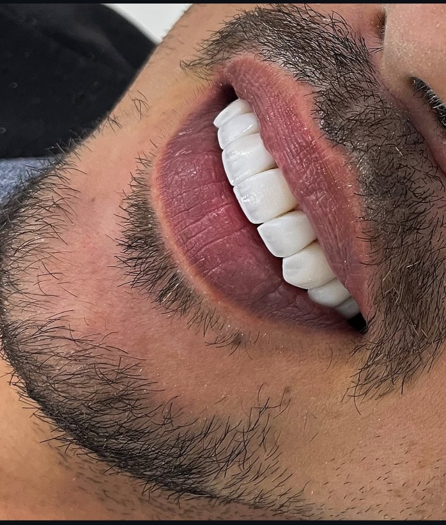 Detalhe de 10 lentes em resina composta