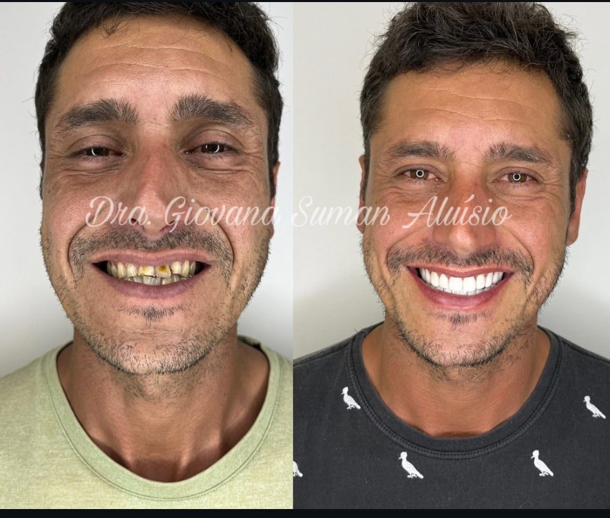 Caso de 20 lentes em resina composta — antes e depois
