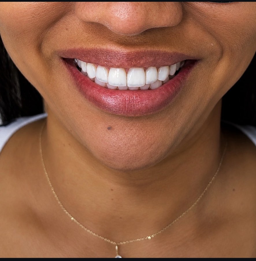 Sorriso finalizado com 20 lentes estratificadas