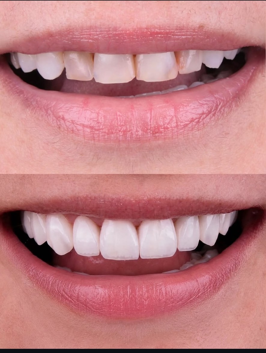 Caso de 10 lentes em resina composta estratificada — antes e depois